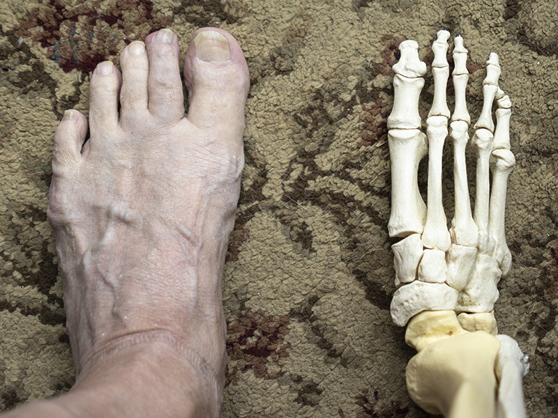 ~~26 Bones in the Foot~~
